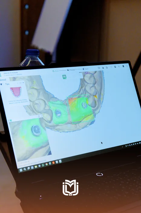 Laptop showing a 3D dental scan with implant scan bodies